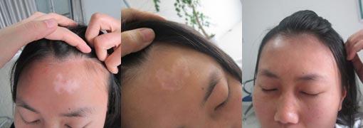 重庆皮肤病医院治疗白癜风案例图,重庆皮肤科医院治疗白癜风怎么样_好不好_多少钱_白癜风症状图