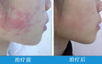 皮炎到重庆市西南医院治疗好吗