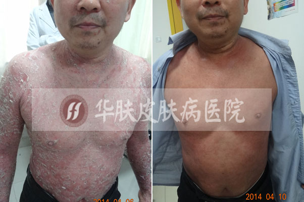 治疗皮肤病重庆人民医院的特殊方法