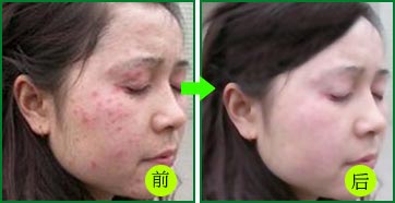 皮炎治疗前后效果图