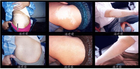 鱼鳞病重庆哪里治疗好[西南医院]