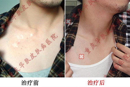 重庆西南医院治疗白癜风好吗