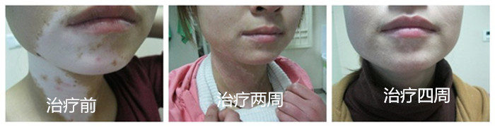 重庆皮肤病医院治疗白癜风案例图,重庆皮肤科医院治疗白癜风怎么样_好不好_多少钱_白癜风症状图
