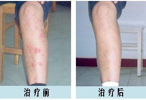 鱼鳞病到重庆西南医院治疗怎么样
