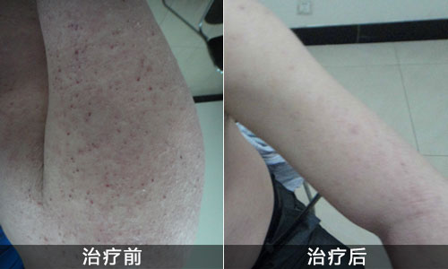 治疗湿疹最好的医院在哪_地址_电话,重庆皮肤科医院