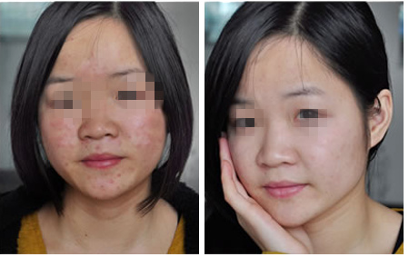 青春痘西南医院皮肤科治疗怎样