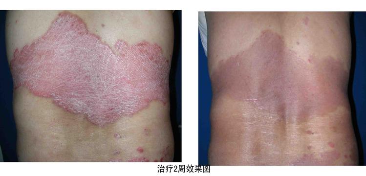 重庆治疗牛皮癣案例图,牛皮癣症状,牛皮癣偏方,牛皮癣治疗效果图