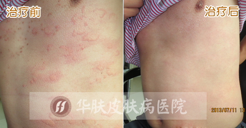 重庆市西南医院皮肤科网上咨询