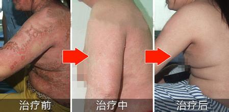 重庆治疗牛皮癣案例图,牛皮癣症状,牛皮癣偏方,牛皮癣治疗效果图