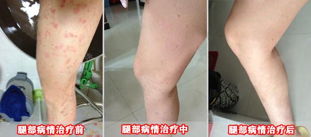 重庆治疗牛皮癣案例图,牛皮癣症状,牛皮癣偏方,牛皮癣治疗效果图