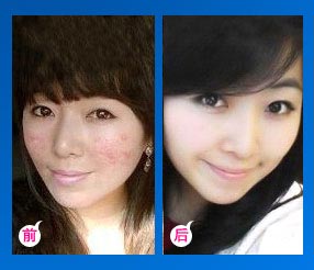重庆西南医院青春痘治疗如何