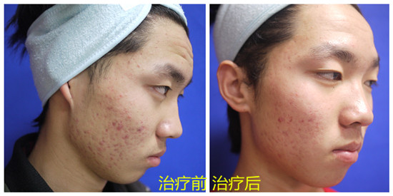 重庆治疗青春痘_痘痘_痘印痘坑_痤疮最好的医院(重庆祛痘最好的医院)青春痘案例图_祛痘效果图_重庆治疗青春痘医院