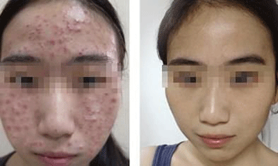 重庆治疗青春痘_痘痘_痘印痘坑_痤疮最好的医院(重庆祛痘最好的医院)青春痘案例图_祛痘效果图_重庆治疗青春痘医院