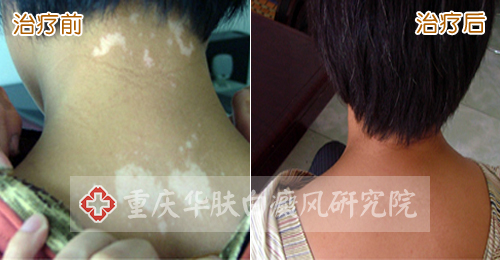 重庆皮肤病医院治疗白癜风案例图,重庆皮肤科医院治疗白癜风怎么样_好不好_多少钱_白癜风症状图